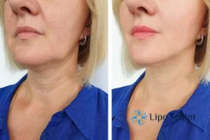 Double chin before and after Hi-Fu treatment 4 Book your double chin treatment Batley today! We are here to help!