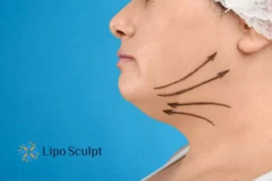 Double chin before and after Hi-Fu treatment 3 Boost your confidence with a Double chin treatment Batley