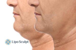 Double chin before and after Hi-Fu treatment 2 Double chin treatment Batley from Lipo Sculpt - feel more confident today!