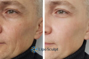 How to Fight Aging Symptoms 3 Fight Aging Symptoms Batley With HIFU and Morpheus8 Today!