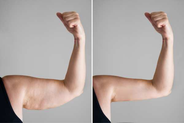 Cellulite's 5 Most Common Causes 1 HIFU before and after