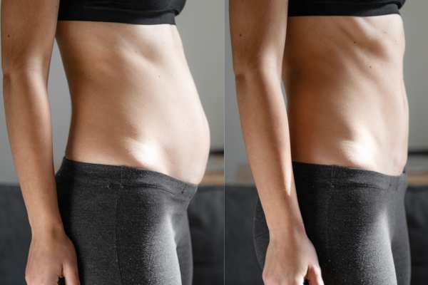 diastasis recti treatment