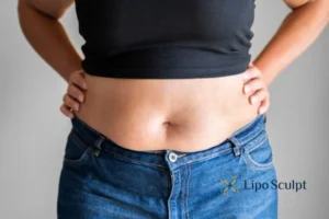 Bidding Farewell to Muffin Tops with Aqualyx Fat Injections 2 Do you wish you could reduce your muffin top Batley With Aqualy fat dissolving injections you can!