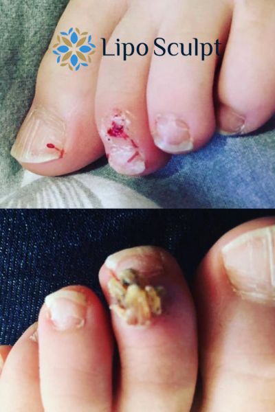 Wart removal customer results from Lipo Sculpt Batley